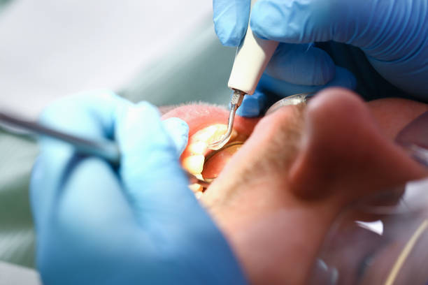 Best Emergency Tooth Extraction in Mexico, IN